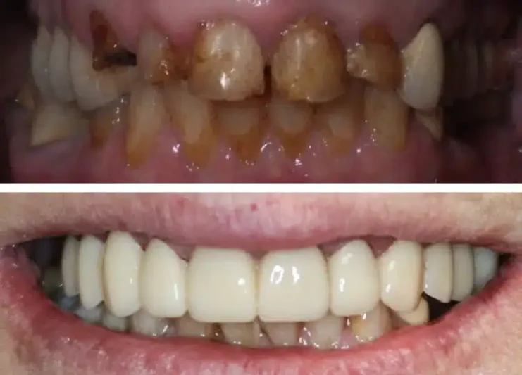 Complete_Smile_Rehabilitation_with_Dental_Implants_Integrative Dental_Wellness