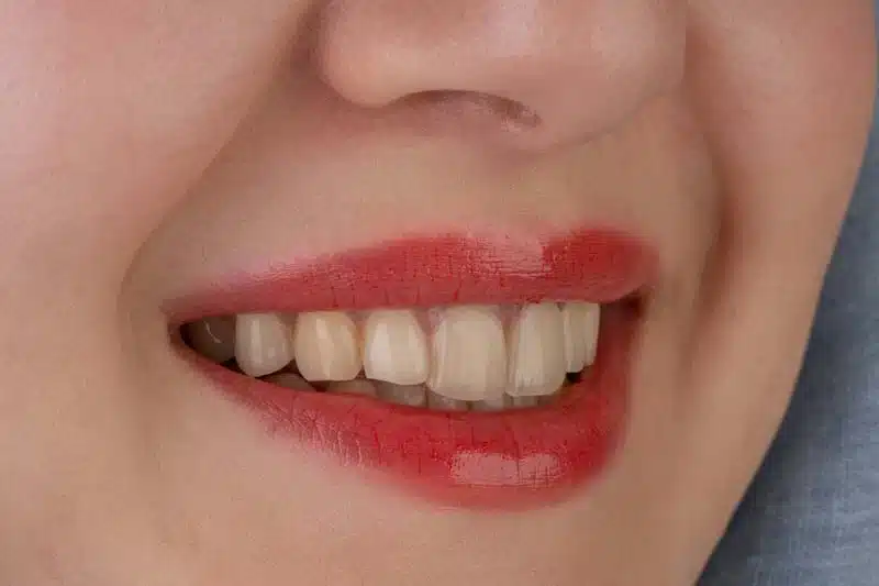 The_Benefits_of_Veneers_Transforming_Your_Smile